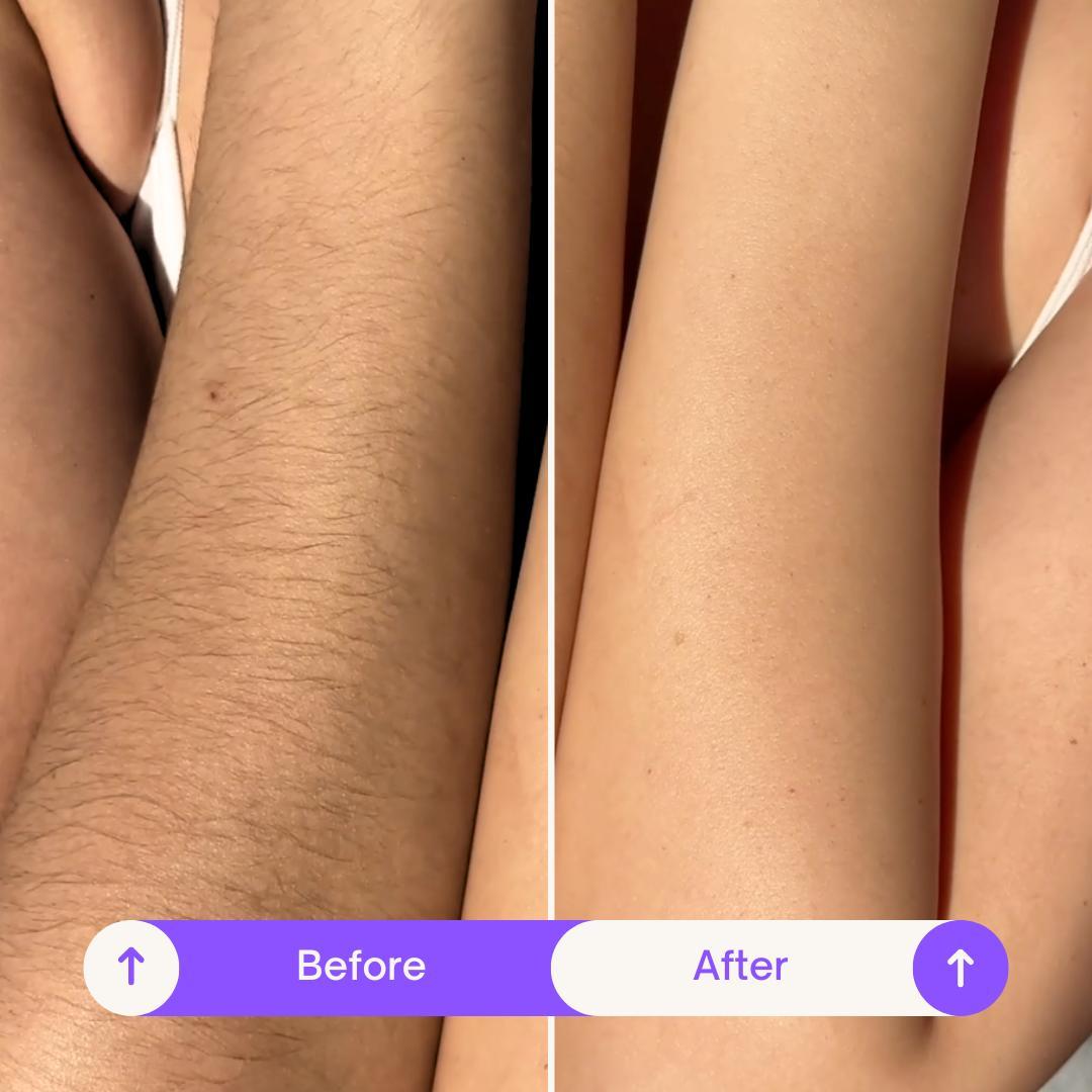 Sensitive Body Hair Removal Cream – 7-Day Smoothness